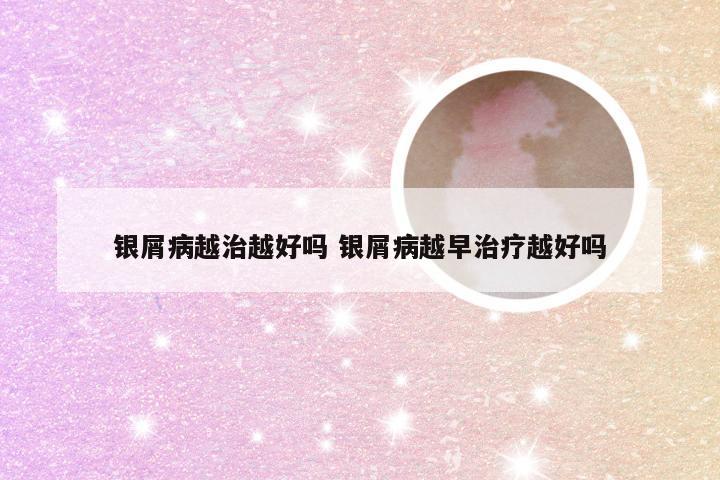 银屑病越治越好吗 银屑病越早治疗越好吗