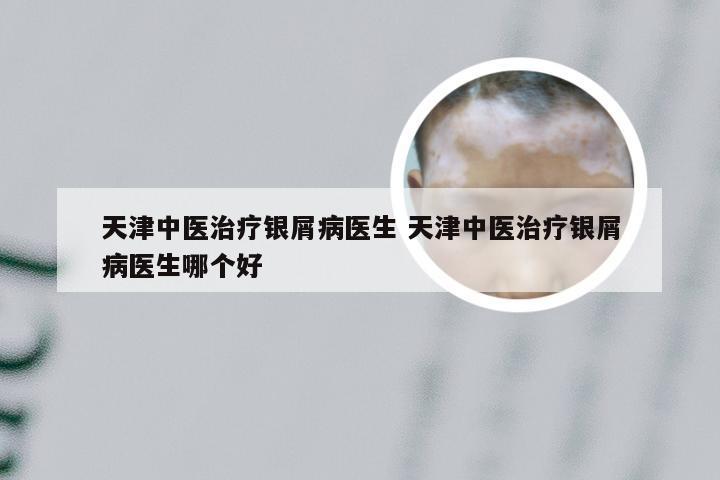 天津中医治疗银屑病医生 天津中医治疗银屑病医生哪个好