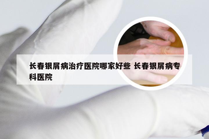 长春银屑病治疗医院哪家好些 长春银屑病专科医院