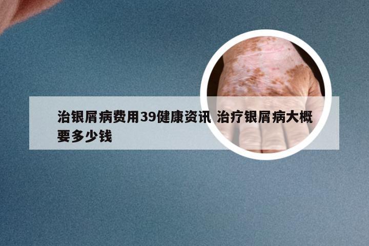 治银屑病费用39健康资讯 治疗银屑病大概要多少钱