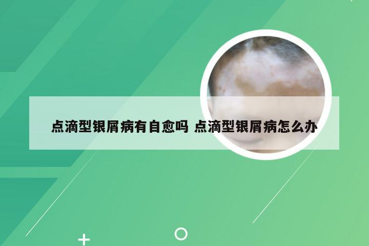 点滴型银屑病有自愈吗 点滴型银屑病怎么办