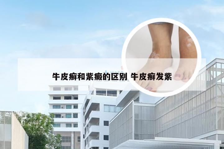 牛皮癣和紫癜的区别 牛皮癣发紫