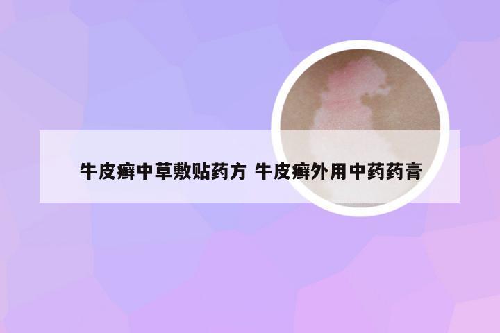 牛皮癣中草敷贴药方 牛皮癣外用中药药膏