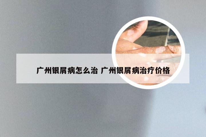 广州银屑病怎么治 广州银屑病治疗价格