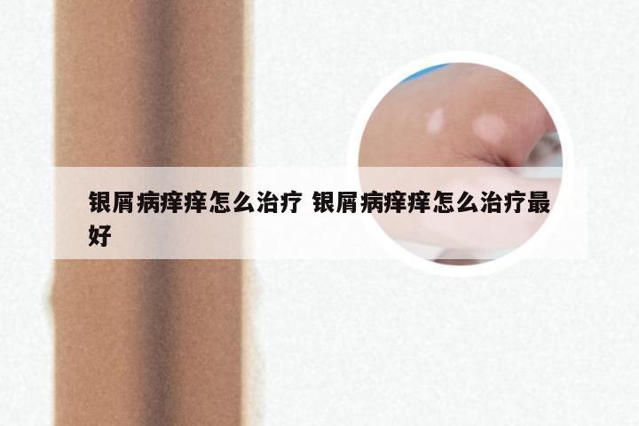 银屑病痒痒怎么治疗 银屑病痒痒怎么治疗最好