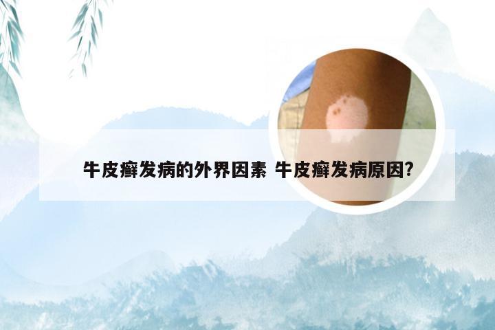牛皮癣发病的外界因素 牛皮癣发病原因?