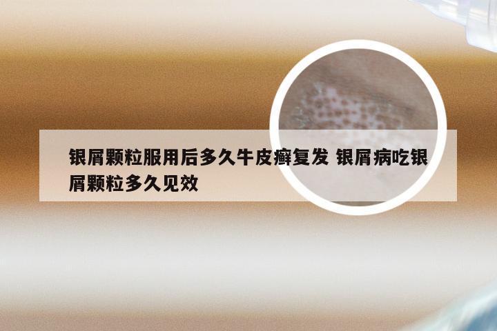 银屑颗粒服用后多久牛皮癣复发 银屑病吃银屑颗粒多久见效