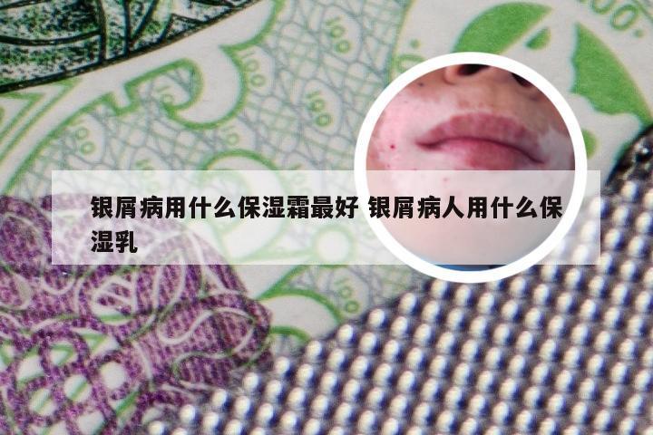 银屑病用什么保湿霜最好 银屑病人用什么保湿乳