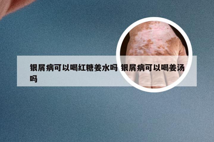 银屑病可以喝红糖姜水吗 银屑病可以喝姜汤吗