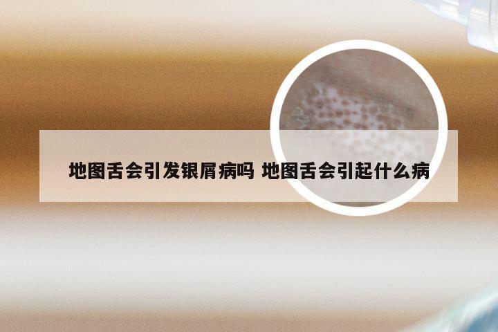 地图舌会引发银屑病吗 地图舌会引起什么病