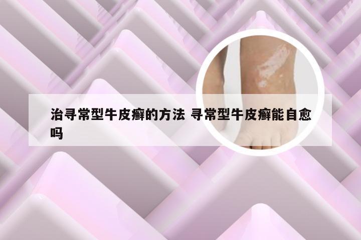 治寻常型牛皮癣的方法 寻常型牛皮癣能自愈吗