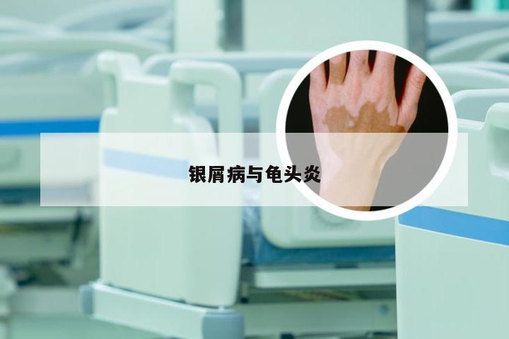 银屑病与龟头炎