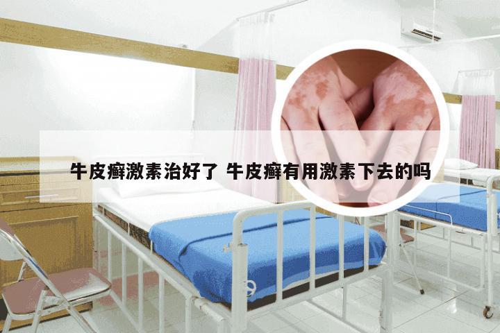 牛皮癣激素治好了 牛皮癣有用激素下去的吗