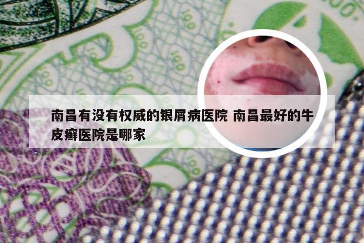 南昌有没有权威的银屑病医院 南昌最好的牛皮癣医院是哪家