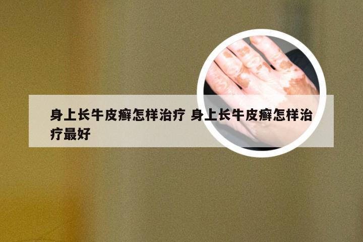 身上长牛皮癣怎样治疗 身上长牛皮癣怎样治疗最好