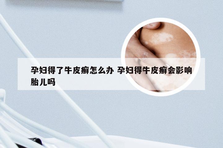 孕妇得了牛皮癣怎么办 孕妇得牛皮癣会影响胎儿吗