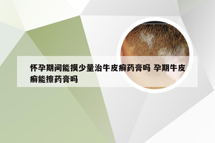 怀孕期间能摸少量治牛皮癣药膏吗 孕期牛皮癣能擦药膏吗