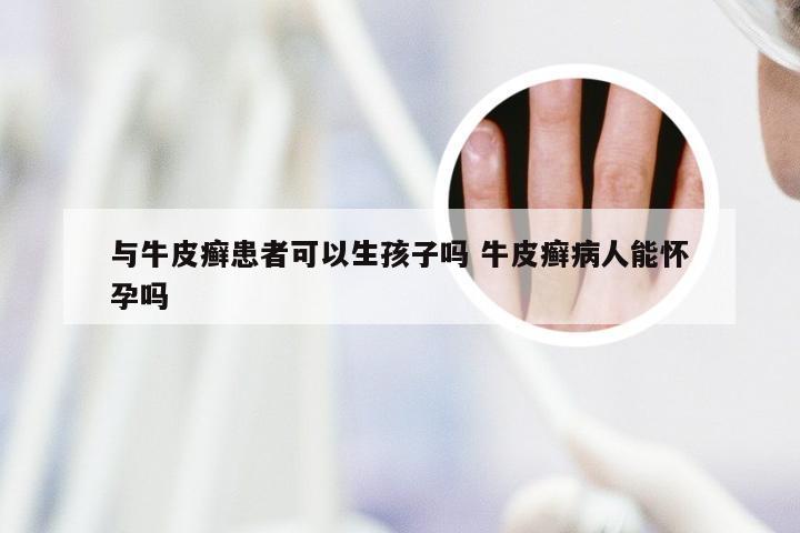 与牛皮癣患者可以生孩子吗 牛皮癣病人能怀孕吗