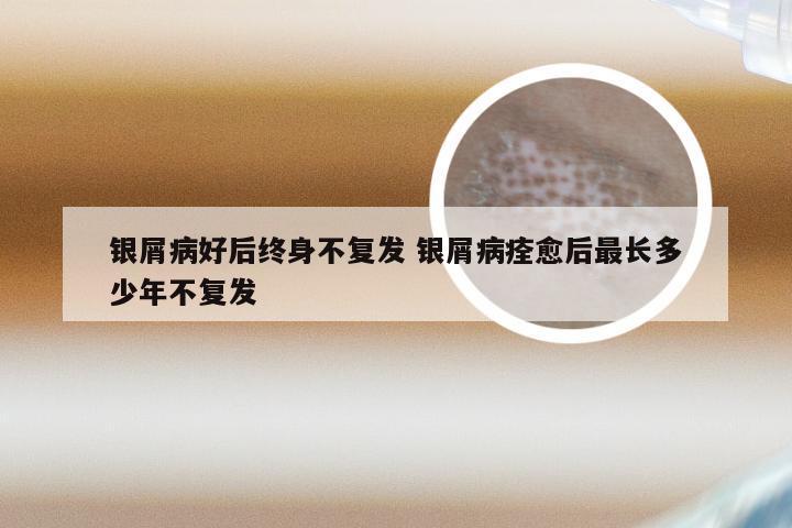 银屑病好后终身不复发 银屑病痊愈后最长多少年不复发