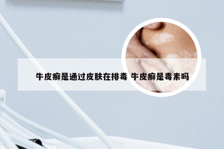 牛皮癣是通过皮肤在排毒 牛皮癣是毒素吗