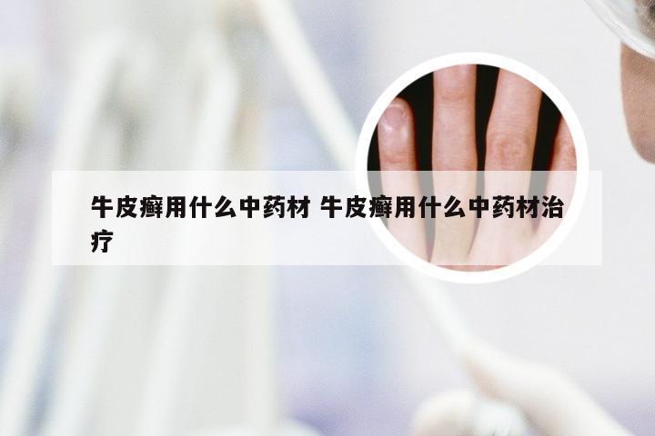 牛皮癣用什么中药材 牛皮癣用什么中药材治疗