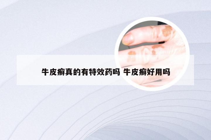 牛皮癣真的有特效药吗 牛皮癣好用吗