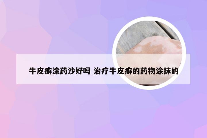 牛皮癣涂药沙好吗 治疗牛皮癣的药物涂抹的