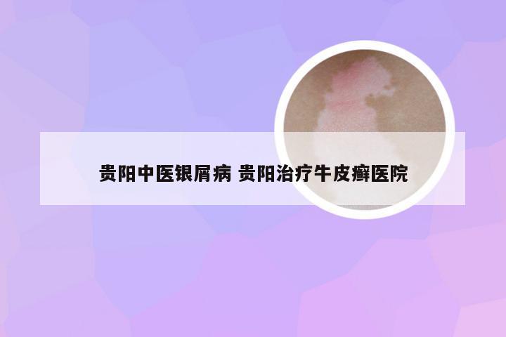 贵阳中医银屑病 贵阳治疗牛皮癣医院