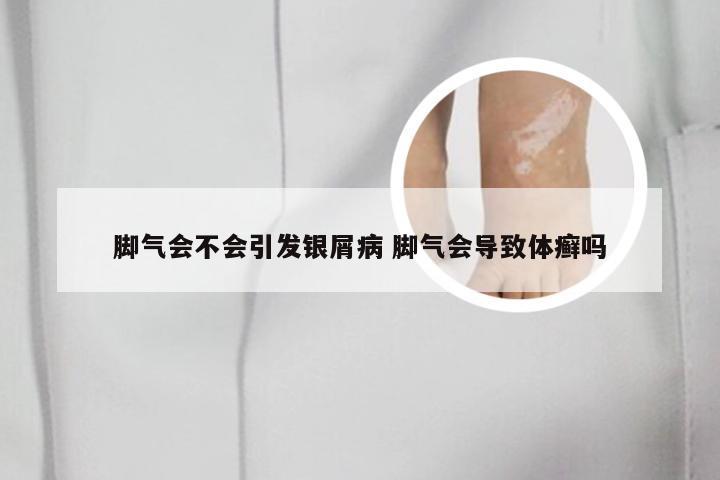 脚气会不会引发银屑病 脚气会导致体癣吗