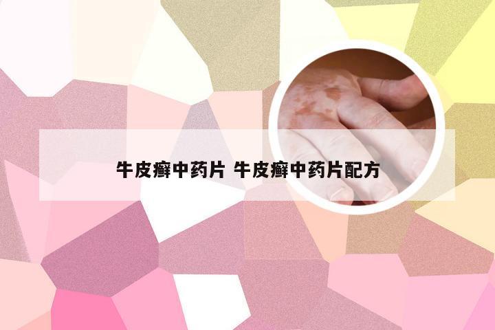 牛皮癣中药片 牛皮癣中药片配方