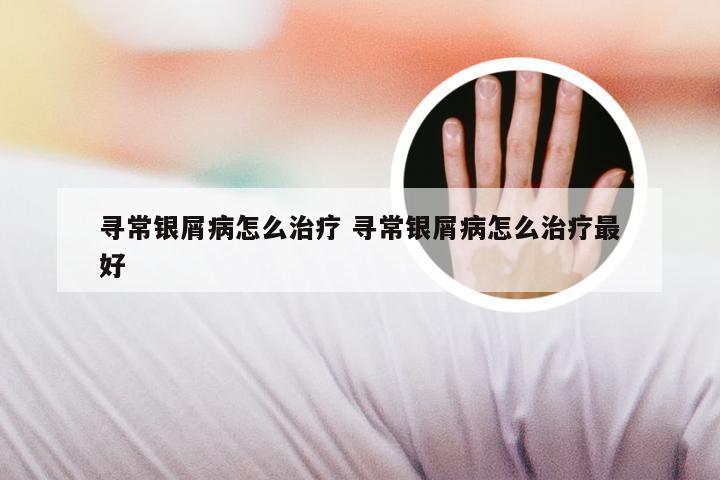 寻常银屑病怎么治疗 寻常银屑病怎么治疗最好