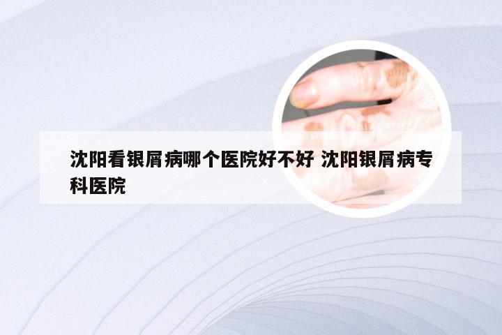 沈阳看银屑病哪个医院好不好 沈阳银屑病专科医院