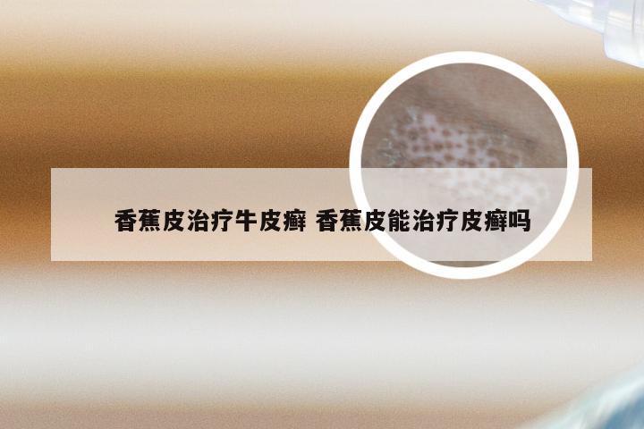 香蕉皮治疗牛皮癣 香蕉皮能治疗皮癣吗