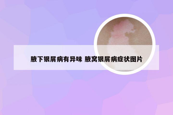 腋下银屑病有异味 腋窝银屑病症状图片