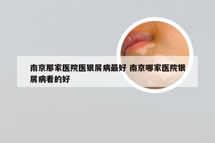 南京那家医院医银屑病最好 南京哪家医院银屑病看的好