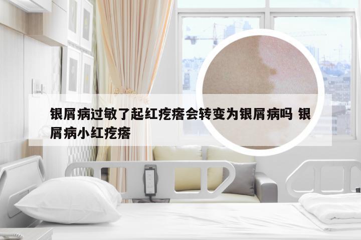银屑病过敏了起红疙瘩会转变为银屑病吗 银屑病小红疙瘩