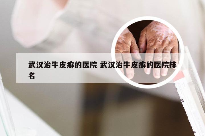 武汉治牛皮癣的医院 武汉治牛皮癣的医院排名
