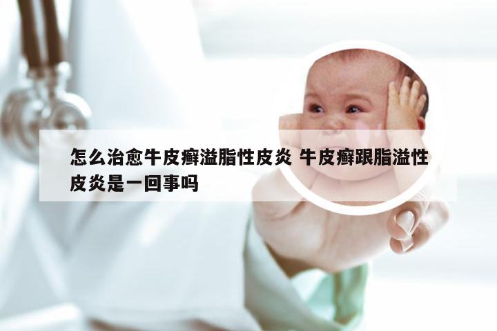 怎么治愈牛皮癣溢脂性皮炎 牛皮癣跟脂溢性皮炎是一回事吗