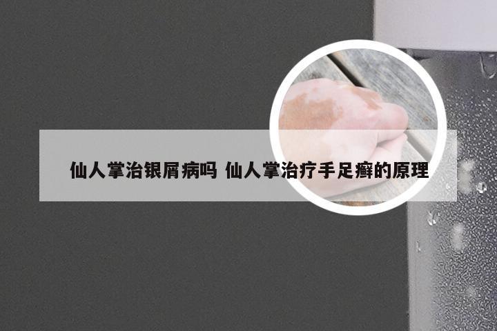 仙人掌治银屑病吗 仙人掌治疗手足癣的原理