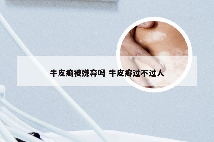 牛皮癣被嫌弃吗 牛皮癣过不过人