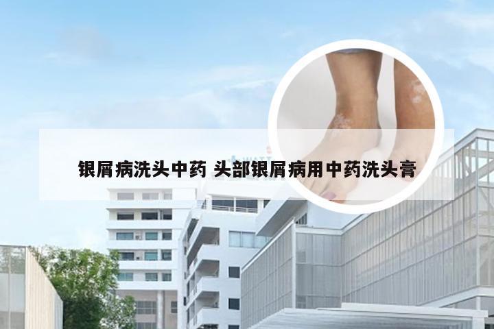银屑病洗头中药 头部银屑病用中药洗头膏