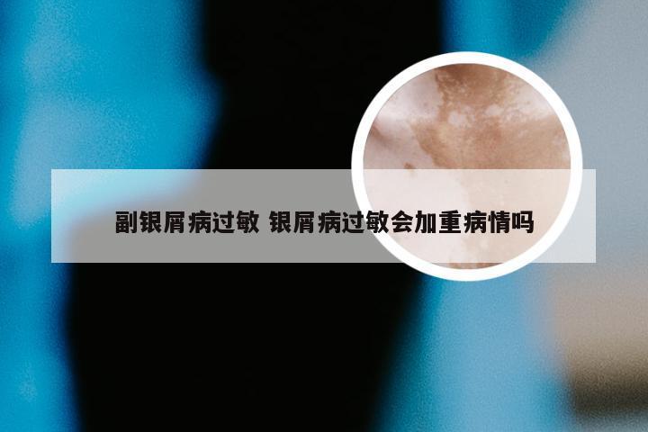 副银屑病过敏 银屑病过敏会加重病情吗