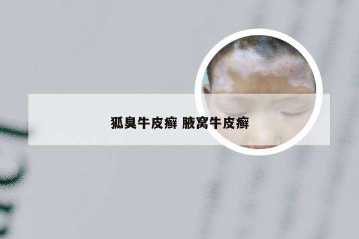 狐臭牛皮癣 腋窝牛皮癣