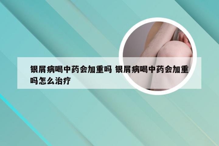 银屑病喝中药会加重吗 银屑病喝中药会加重吗怎么治疗