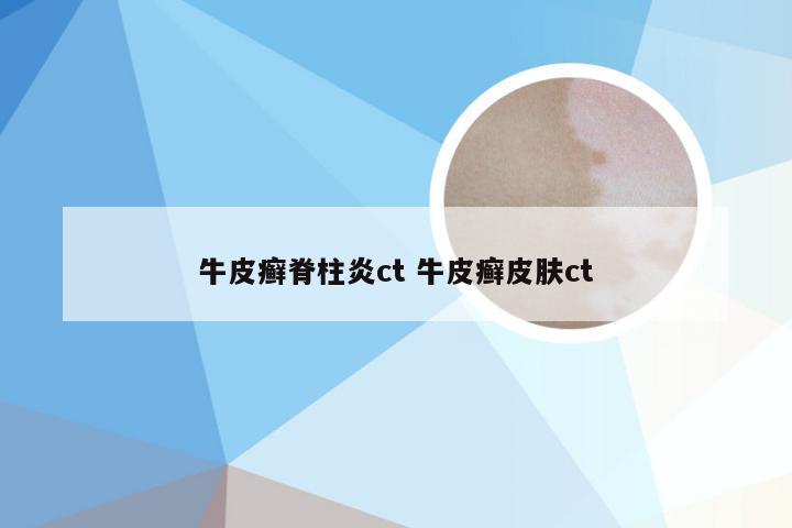 牛皮癣脊柱炎ct 牛皮癣皮肤ct