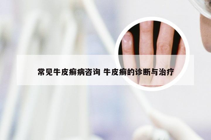 常见牛皮癣病咨询 牛皮癣的诊断与治疗