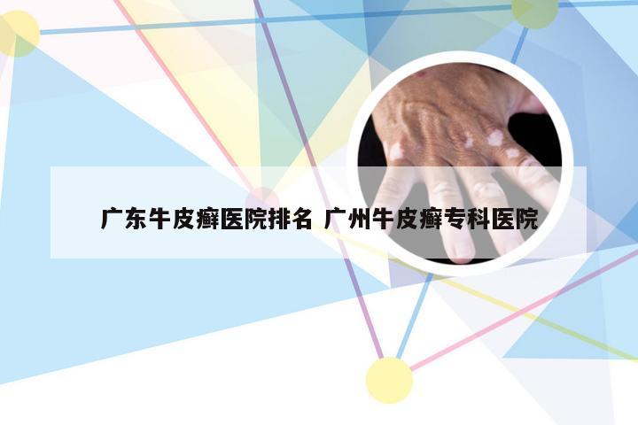 广东牛皮癣医院排名 广州牛皮癣专科医院