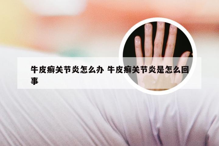 牛皮癣关节炎怎么办 牛皮癣关节炎是怎么回事