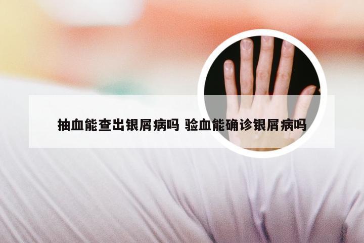 抽血能查出银屑病吗 验血能确诊银屑病吗