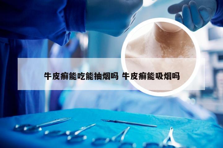 牛皮癣能吃能抽烟吗 牛皮癣能吸烟吗